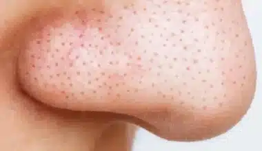 What Are Blackheads?
